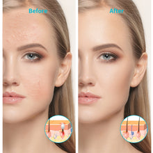 Load image into Gallery viewer, XPREEN XPRE052 Wireless Rechargeable Light Acne Treatment Device Home Acne Clearing Eraser with Blue Light and Red Light, XPRE052