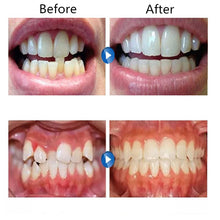 Load image into Gallery viewer, Orthodontic Appliance Silicone Simulation Braces Anti-molar Braces for Night, The first stage, The second stage, The third stage