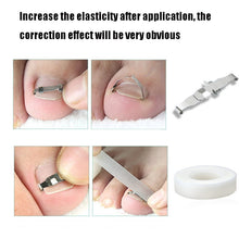 Load image into Gallery viewer, Orthopedic Buckle Toe Nail Groove Ingrown Nail Corrector, No. 36 Positive Nail Buckle, No. 38 Positive Nail Buckle, No. 40 Positive Nail Buckle, No. 42 Positive Nail Buckle, No. 44 Positive Nail Buckle, No. 36 Set, No. 38 Set, No. 40 Set, No. 42 Set   ...