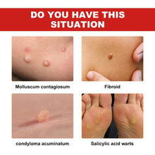 Load image into Gallery viewer, Ximonth 20ml/Bottle Anti Mole And Wart Liquid Dark Spot Tag Remover Skin Essence