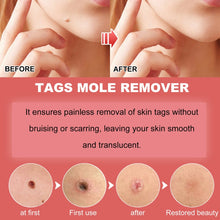 Load image into Gallery viewer, Ximonth 20ml/Bottle Anti Mole And Wart Liquid Dark Spot Tag Remover Skin Essence