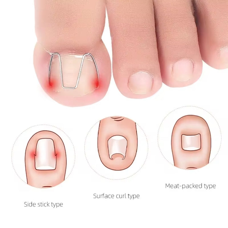 6pcs /Box Ortho Wire Nail Insertion Orthotic Toe Nail Ortho Hooks