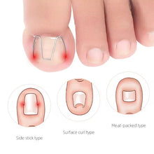 Load image into Gallery viewer, 6pcs /Box Ortho Wire Nail Insertion Orthotic Toe Nail Ortho Hooks