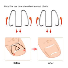 Load image into Gallery viewer, 6pcs /Box Ortho Wire Nail Insertion Orthotic Toe Nail Ortho Hooks